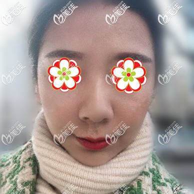 打玻尿酸+瘦臉術(shù)后1個月恢復(fù)照