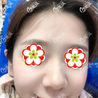 注射玻尿酸瘦臉術(shù)后2個月時的效果照