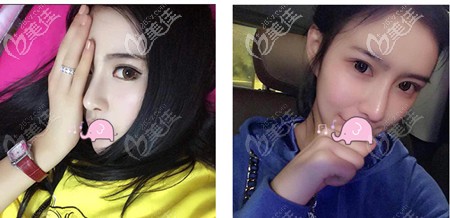 耳軟骨復(fù)合隆鼻側(cè)臉效果圖 耳軟骨復(fù)合隆鼻側(cè)臉效果圖