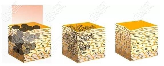 溫州名人激光祛斑優(yōu)勢