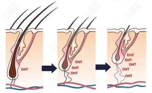 服用非那雄胺片的治脫原理
