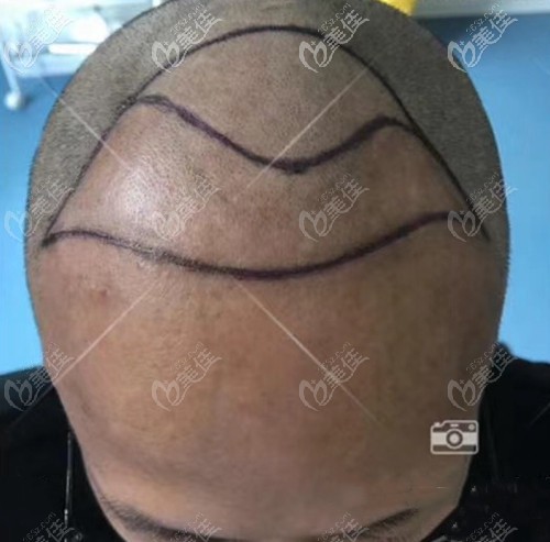 四級脫發(fā)的我頭頂已經大面積光禿