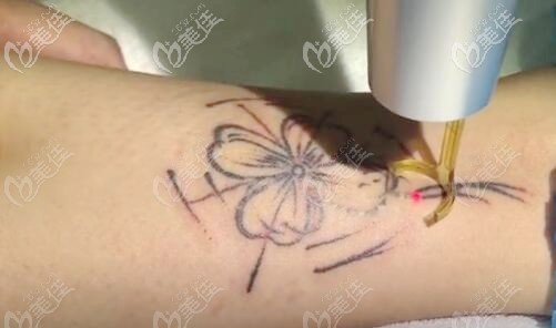 造成皮秒洗紋身多次不掉的原因