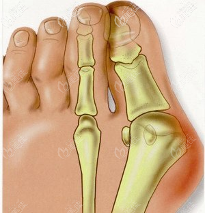 拇指外翻需要做手術(shù) 拇指外翻需要做手術(shù)