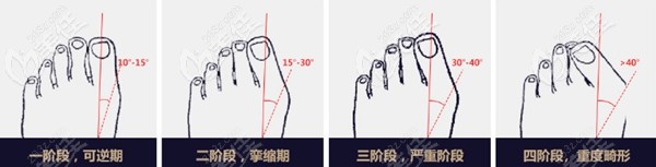 大腳骨的幾個(gè)階段 大腳骨的幾個(gè)階段