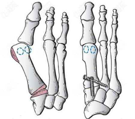 大腳骨手術(shù) 大腳骨手術(shù)