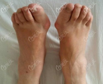 大腳骨圖片 大腳骨圖片