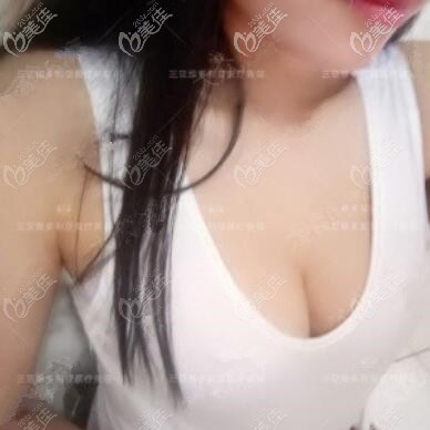 自體脂肪豐胸術(shù)后4天照 自體脂肪豐胸術(shù)后4天照