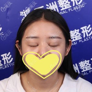 雙眼皮做失敗閉眼疤痕明顯