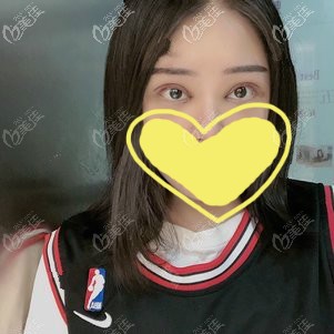 雙眼皮失敗二次修復(fù)一個月效果圖