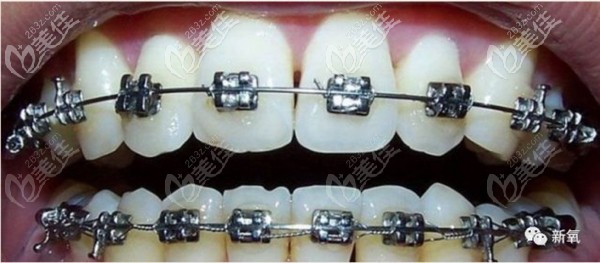普通鋼絲牙套矯正器