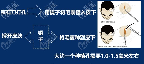 植發(fā)手術(shù)種植過程