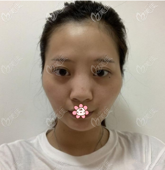 術(shù)前的我 術(shù)前的我