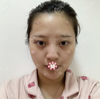 陶亮醫(yī)生給我做完脂肪填充一周 陶亮醫(yī)生給我做完脂肪填充一周