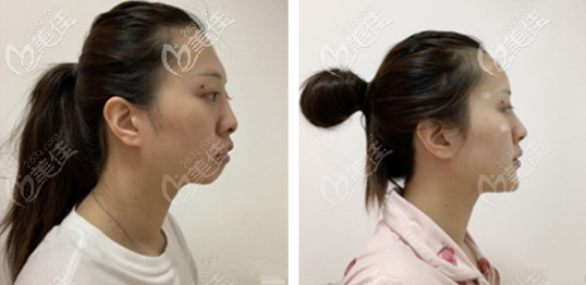 前后對比照片 前后對比照片