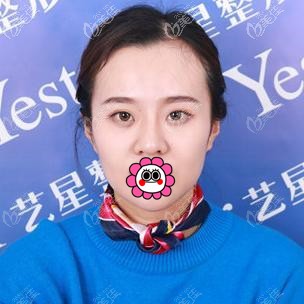 到嘉興藝星做肋軟骨隆鼻前 到嘉興藝星做肋軟骨隆鼻前