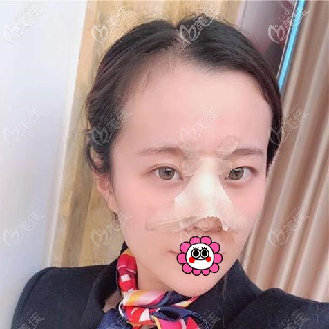 肋軟骨隆鼻術(shù)后恢復(fù)五天效果 肋軟骨隆鼻術(shù)后恢復(fù)五天效果