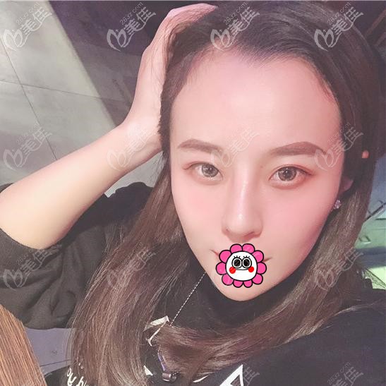 肋軟骨隆鼻恢復(fù)半個月 肋軟骨隆鼻恢復(fù)半個月