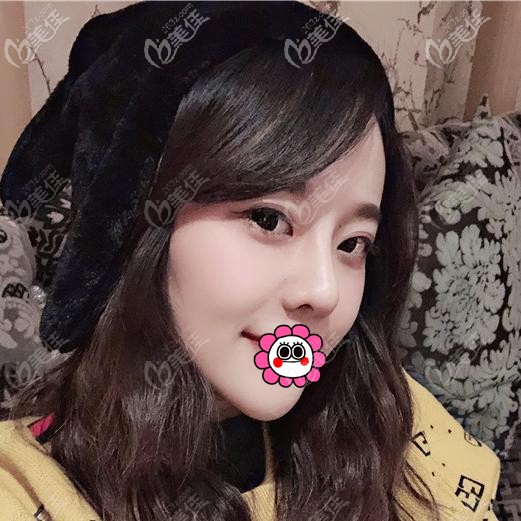 肋軟骨隆鼻恢復(fù)兩個月基本穩(wěn)定 肋軟骨隆鼻恢復(fù)兩個月基本穩(wěn)定