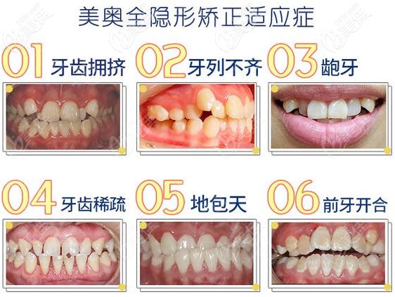 蘇州美奧口腔正雅隱形矯正適應(yīng)癥 蘇州美奧口腔正雅隱形矯正適應(yīng)癥