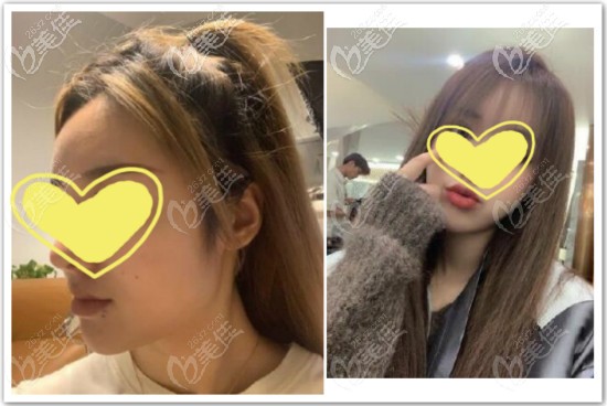 我找上海韓鏡金一秀做長(zhǎng)曲線下頜角截骨術(shù)后一年效果圖片 我找上海韓鏡金一秀做長(zhǎng)曲線下頜角截骨術(shù)后一年效果圖片