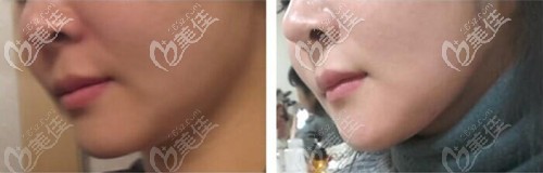 下頜緣吸脂術(shù)后效果