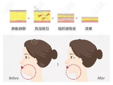 吸脂手術(shù)瘦下巴過程