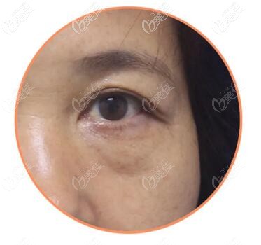 松弛型眼袋 松弛型眼袋