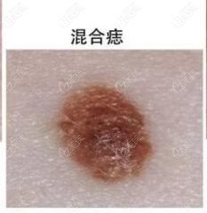 混合痣