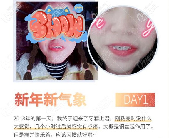 成都圣貝金屬牙齒矯正剛開始 成都圣貝金屬牙齒矯正剛開始