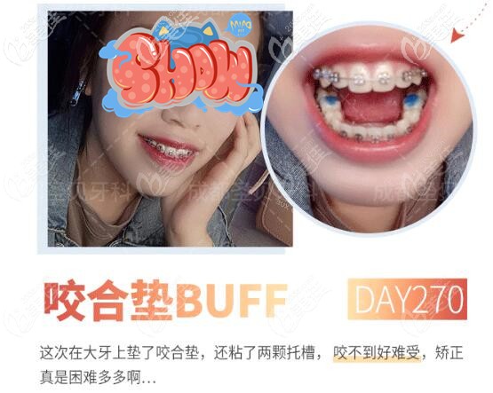 成都圣貝牙齒矯正過程 成都圣貝牙齒矯正過程