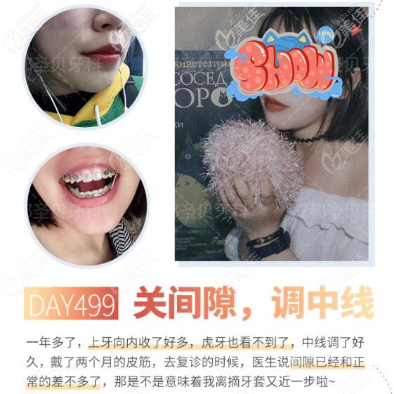 成都圣貝牙科牙齒矯正過程 成都圣貝牙科牙齒矯正過程