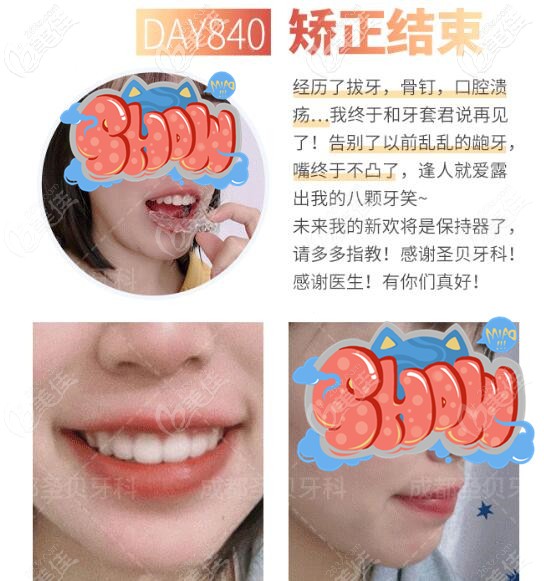 圣貝口腔矯正牙齒照片 圣貝口腔矯正牙齒照片