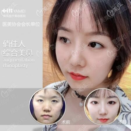 雅美鼻部整形真人案例圖