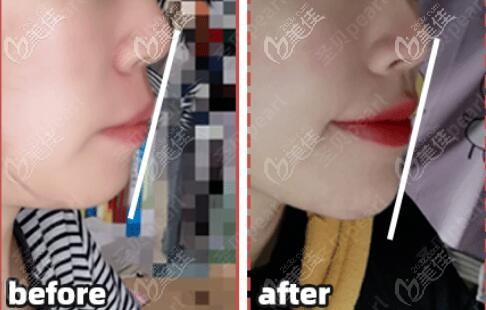 成都牙齒矯正哪家醫(yī)院比較好，先看看我這個齙牙妹戴自鎖托槽牙套的血淚史吧