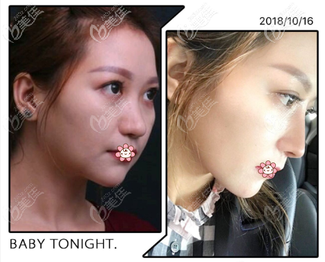 重慶好美畢醫(yī)生做鼻子可以，我做的肋軟骨鼻綜合半年后沒鈣化