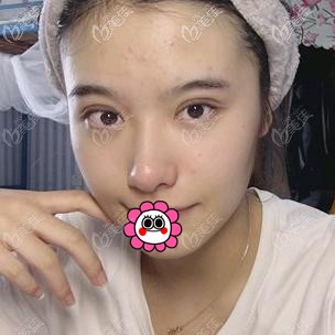 拆線后的雙眼皮效果 拆線后的雙眼皮效果