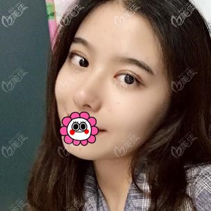 全切雙眼皮術(shù)后恢復(fù)一個月效果 全切雙眼皮術(shù)后恢復(fù)一個月效果