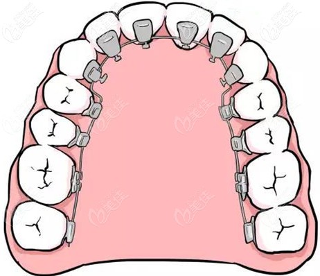 全隱形舌側(cè)矯正器