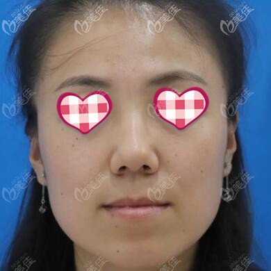 做埋線提升術前照 做埋線提升術前照