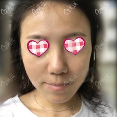 面部年輕化術后第3天效果 面部年輕化術后第3天效果