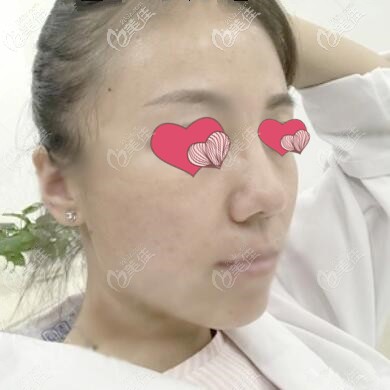 面部提升術后一周效果照 面部提升術后一周效果照