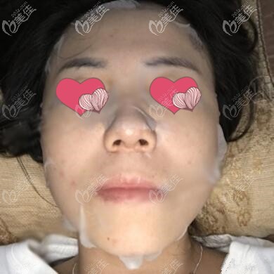 面部埋線提升術后半個月效果照 面部埋線提升術后半個月效果照