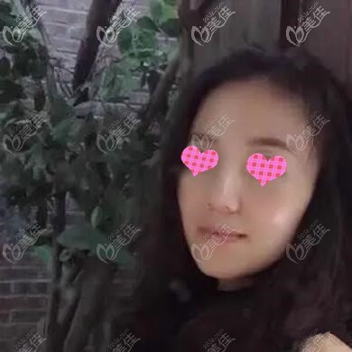 做面部埋線提升術后40天效果照 做面部埋線提升術后40天效果照