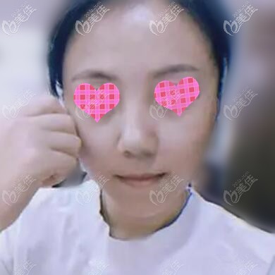 快瞧我找海南蘭顏慧李潤(rùn)琴做面部埋線提升4個(gè)月了國(guó)字臉終于變成小V臉！