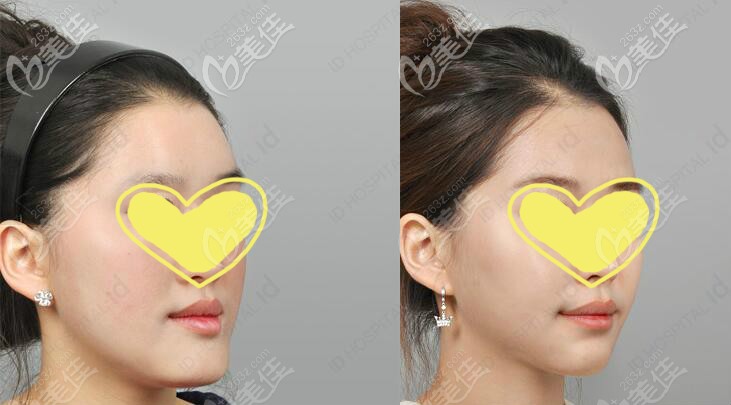 韓國(guó)id醫(yī)院無(wú)矯正雙鄂手術(shù)真人案例效果對(duì)比圖