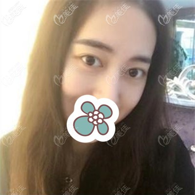 術(shù)后20天的樣子