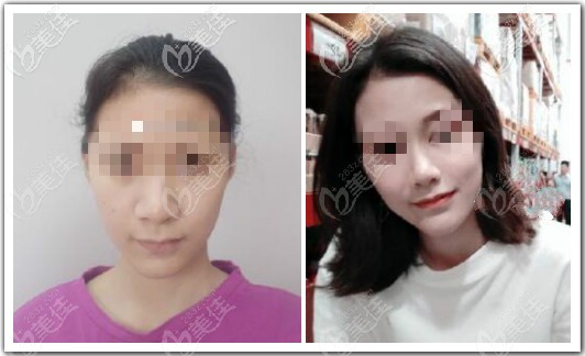 我找昆明吳氏嘉美莊蔚強(qiáng)院長做鼻綜合四項(xiàng)效果對比圖