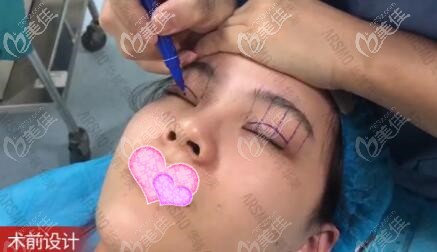 術(shù)前畫線設(shè)計