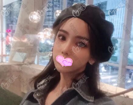 做ARSMO潘多拉美眼術(shù)后45天恢復效果照